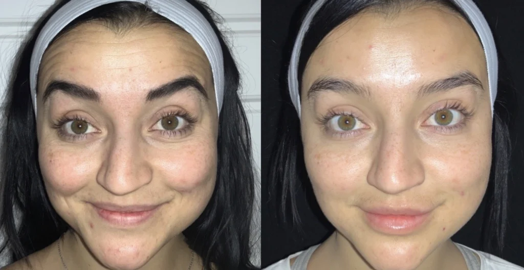 Before and after photo by Jana Kazazic of Fort Worth Medspa in Fort Worth, TX