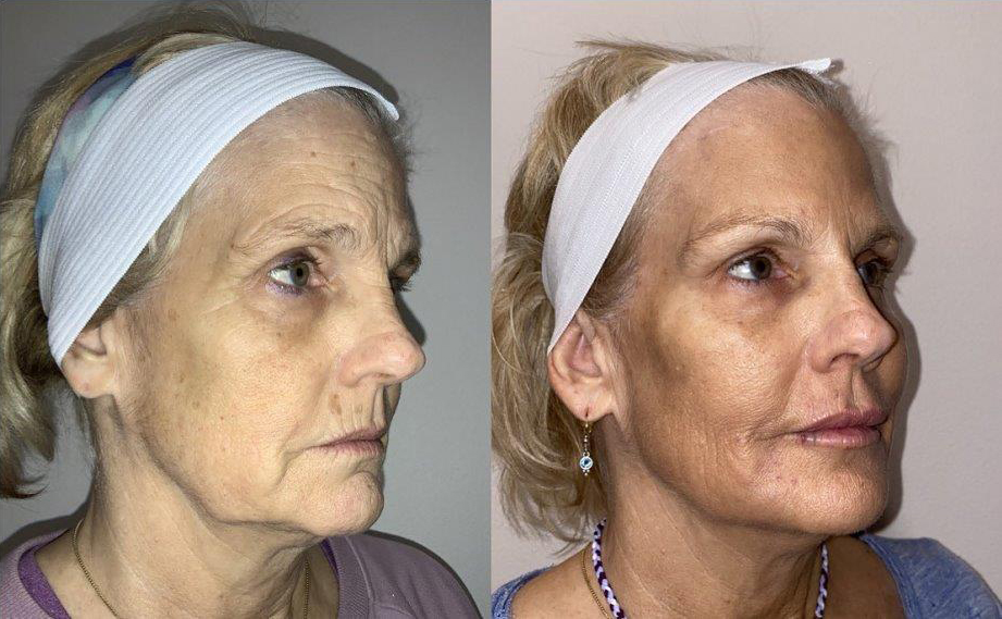 Before and after photo by Jessica Redden of Fort Worth Medspa in Fort Worth, TX