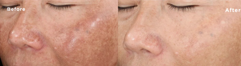 Chemical Peels before and after photo by Fort Worth Medspa in Fort Worth, TX
