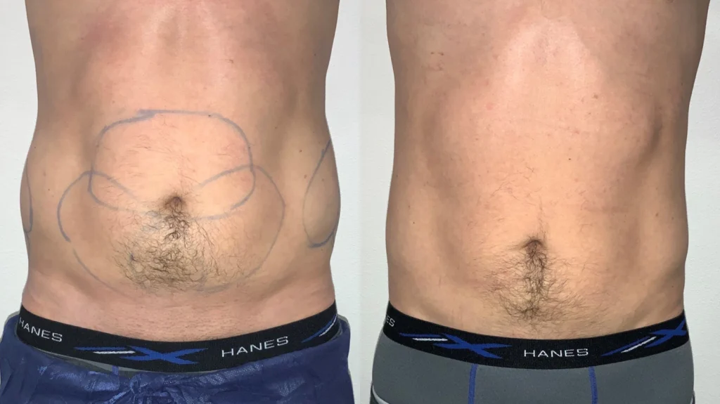 CoolSculpting before and after photo by Fort Worth Medspa in Fort Worth, TX