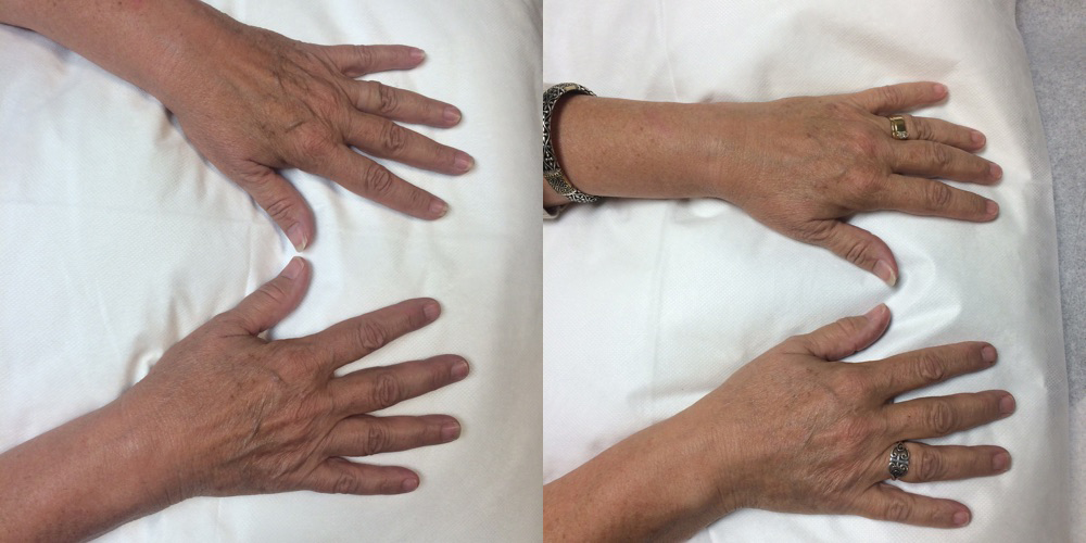 IPL Photo Rejuvenation before and after photo by Fort Worth Medspa in Fort Worth, TX
