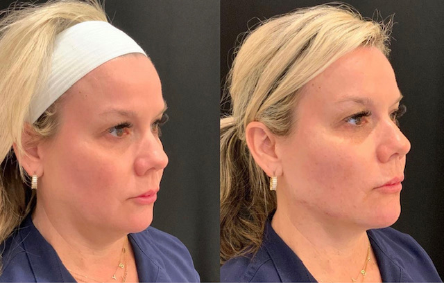 Juvéderm® Volux XC before and after photo by Fort Worth Medspa in Fort Worth, TX