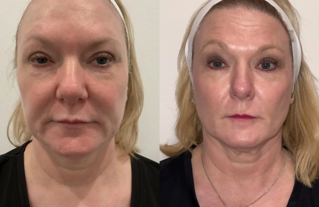 before and after photo by fort worth medspa in fort worth tx