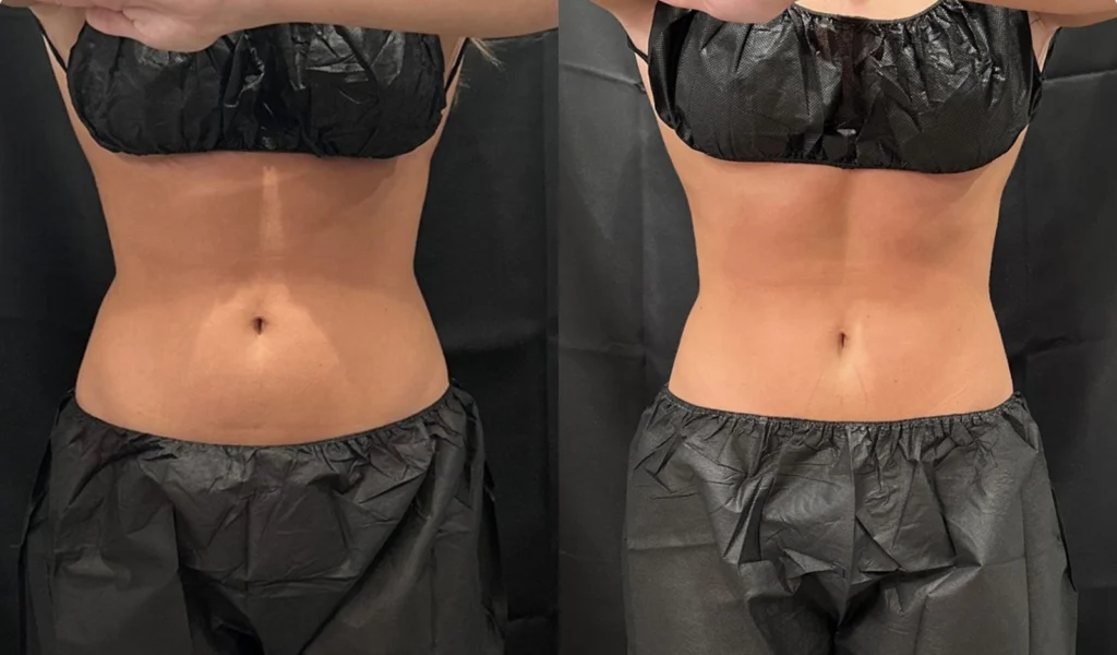 CoolSculpting before and after photo by Fort Worth Medspa in Fort Worth, TX