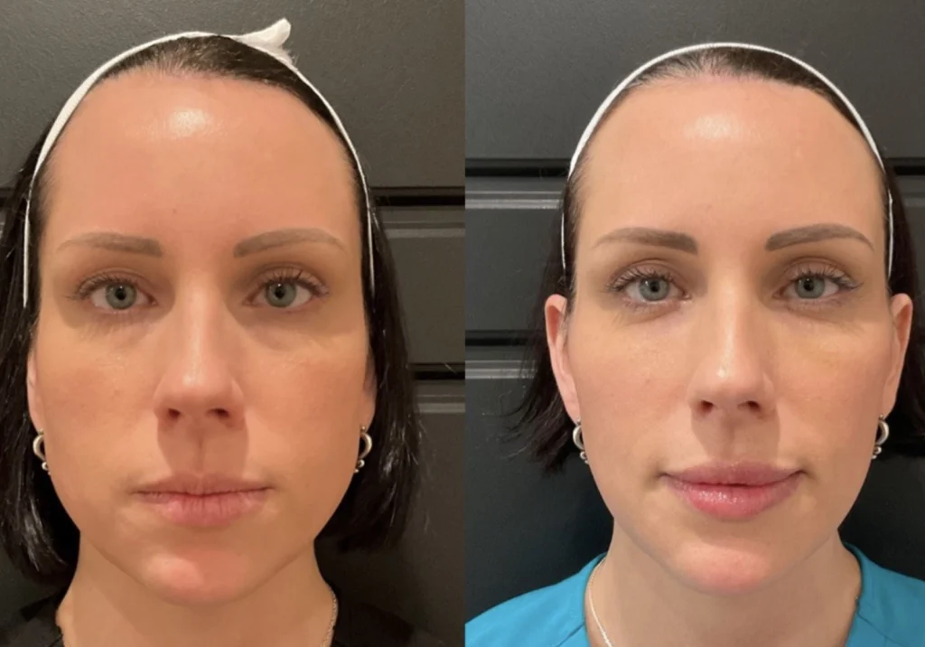 Before and after photo by Jessica Redden of Fort Worth Medspa in Fort Worth, TX