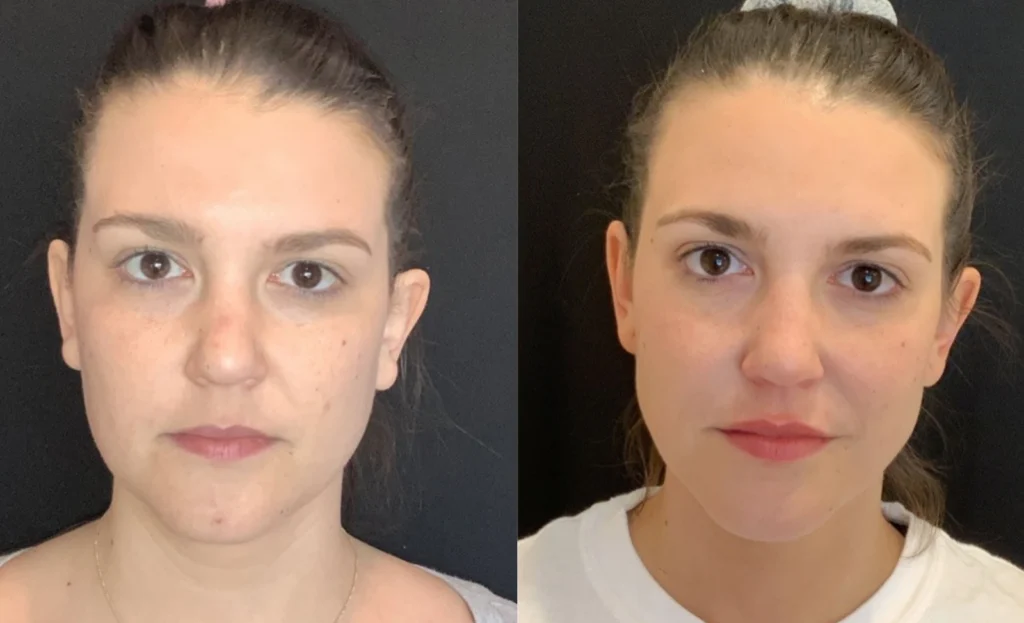before and after photo by fort worth medspa in fort worth tx
