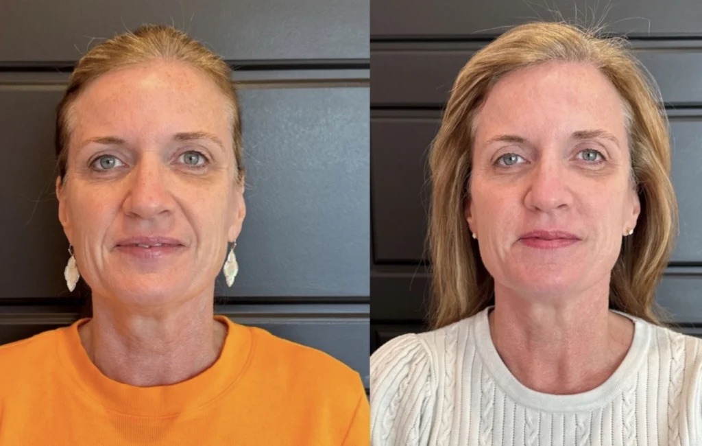 Before and after photo by Tamara Clark of Fort Worth Medspa in Fort Worth, TX
