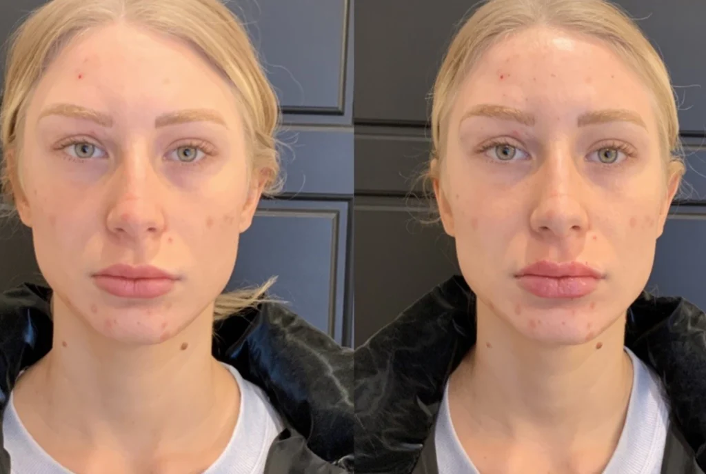 before and after photo by fort worth medspa in fort worth tx