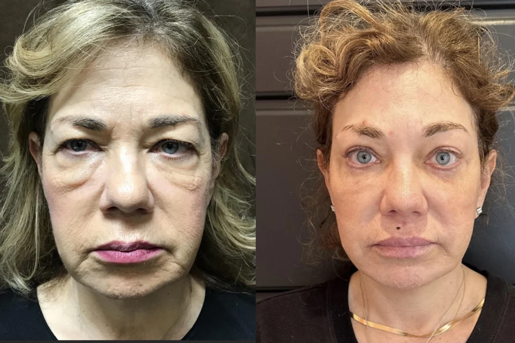 Before and after photo by Tamara Clark of Fort Worth Medspa in Fort Worth, TX