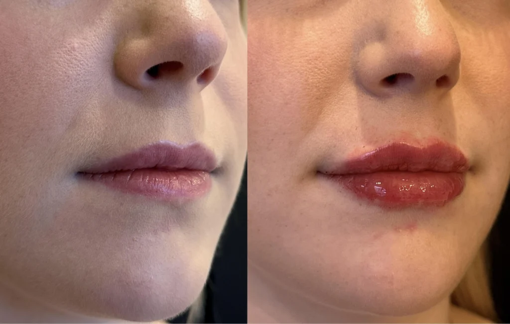 before and after photo by fort worth medspa in fort worth tx