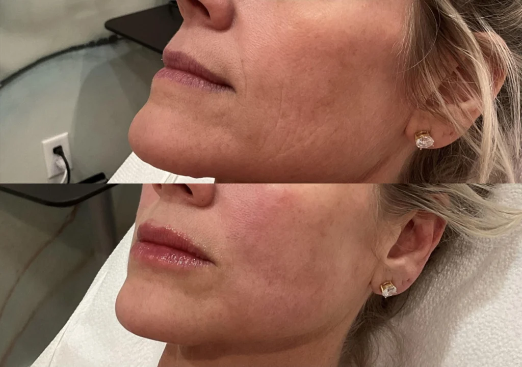 Before and after photo by Jessica Redden of Fort Worth Medspa in Fort Worth, TX
