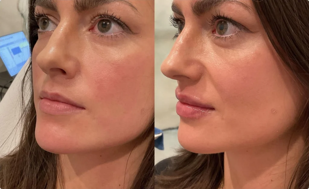 Before and after photo by Jessica Redden of Fort Worth Medspa in Fort Worth, TX