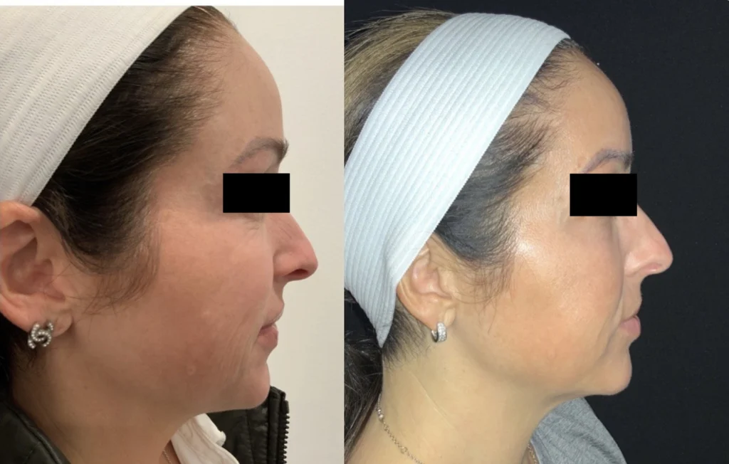 Before and after photo by Jana Kazazic of Fort Worth Medspa in Fort Worth, TX