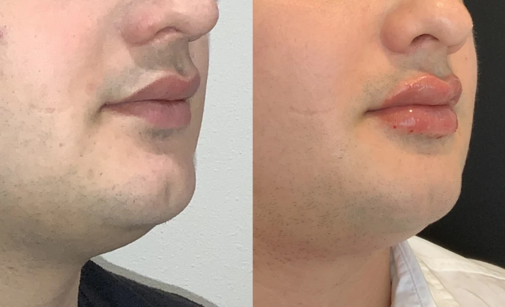 before and after photo by fort worth medspa in fort worth tx