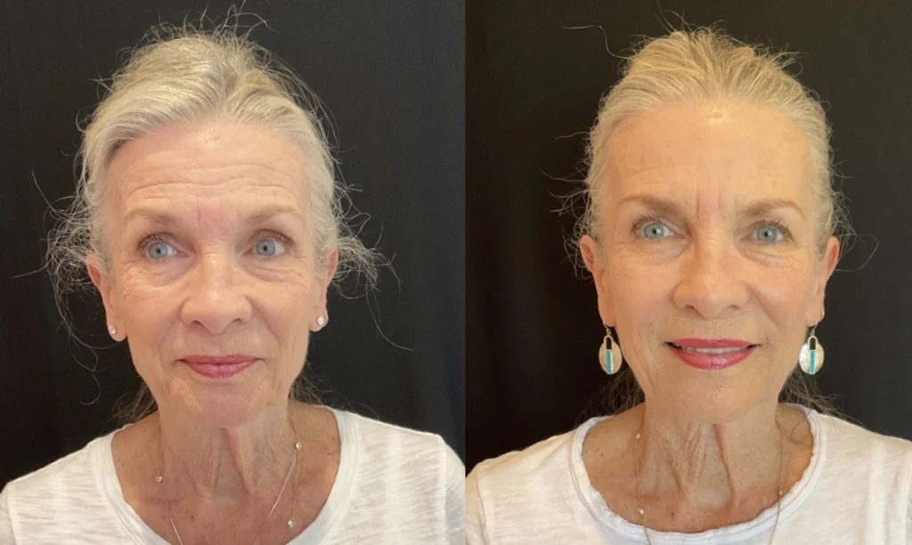 Before and after photo by Tamara Clark of Fort Worth Medspa in Fort Worth, TX