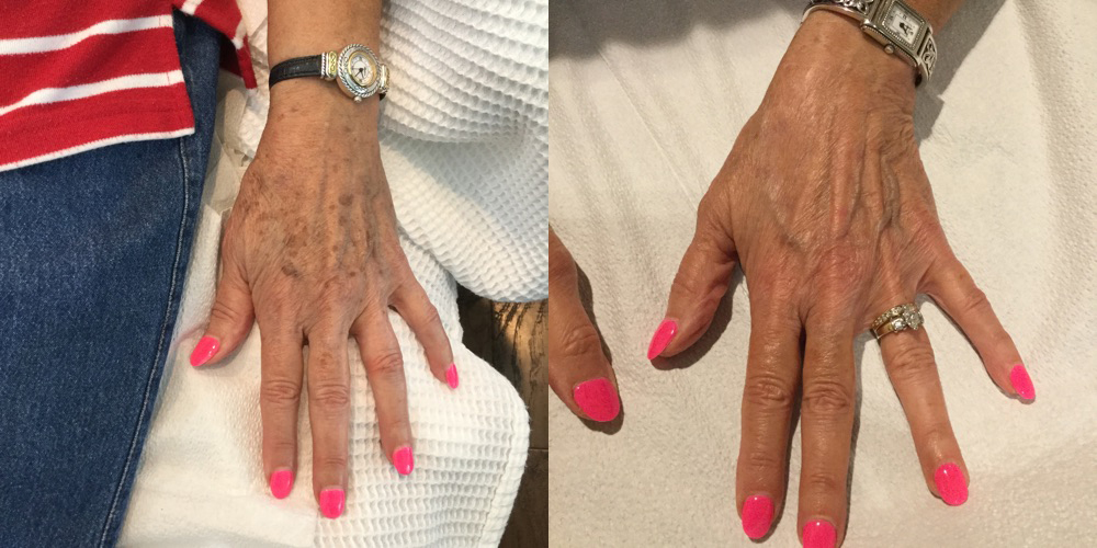 IPL Photo Rejuvenation before and after photo by Fort Worth Medspa in Fort Worth, TX