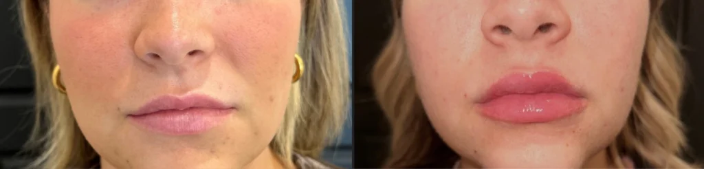 Before and after photo by Hailey Fontana of Fort Worth Medspa in Fort Worth, TX