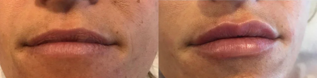 Before and after photo by Jessica Redden of Fort Worth Medspa in Fort Worth, TX