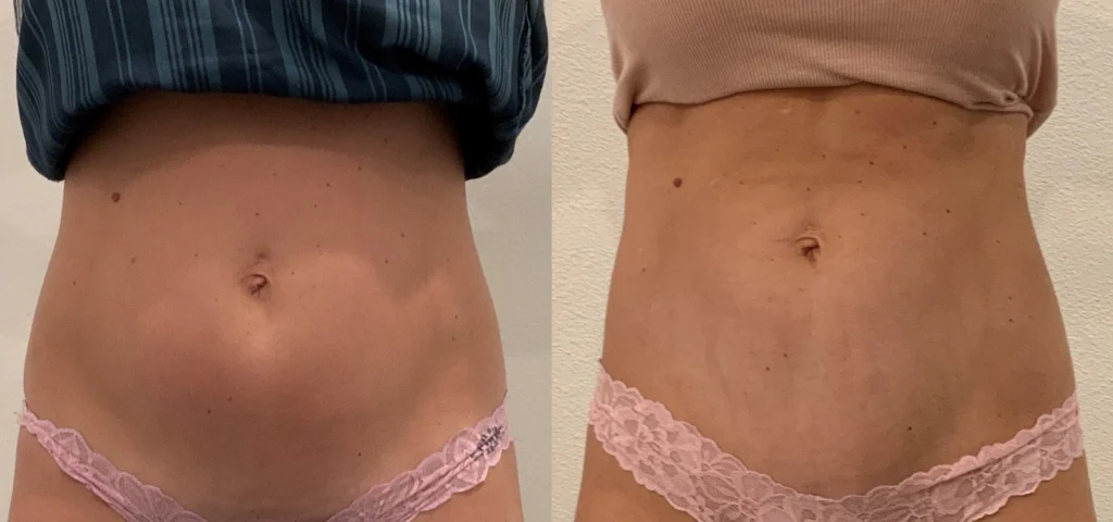 CoolSculpting before and after photo by Fort Worth Medspa in Fort Worth, TX