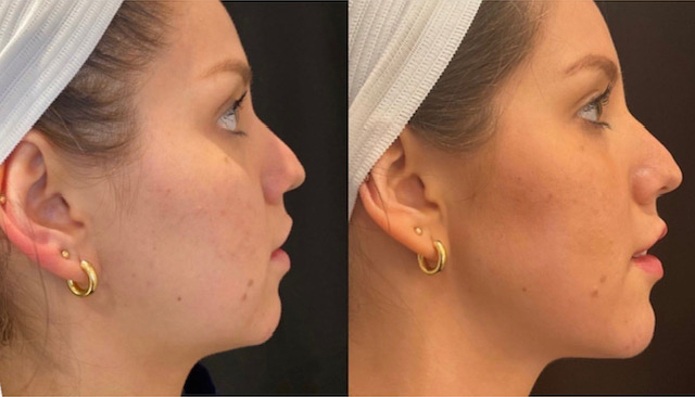 Juvéderm® Volux XC before and after photo by Fort Worth Medspa in Fort Worth, TX
