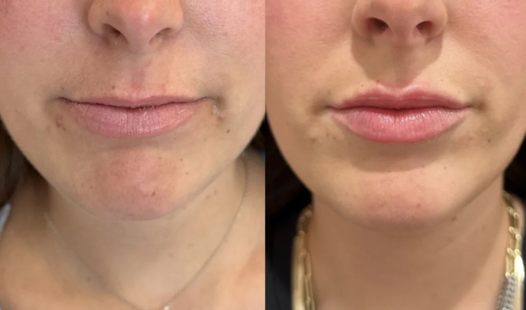 Before and after photo by Hailey Fontana of Fort Worth Medspa in Fort Worth, TX