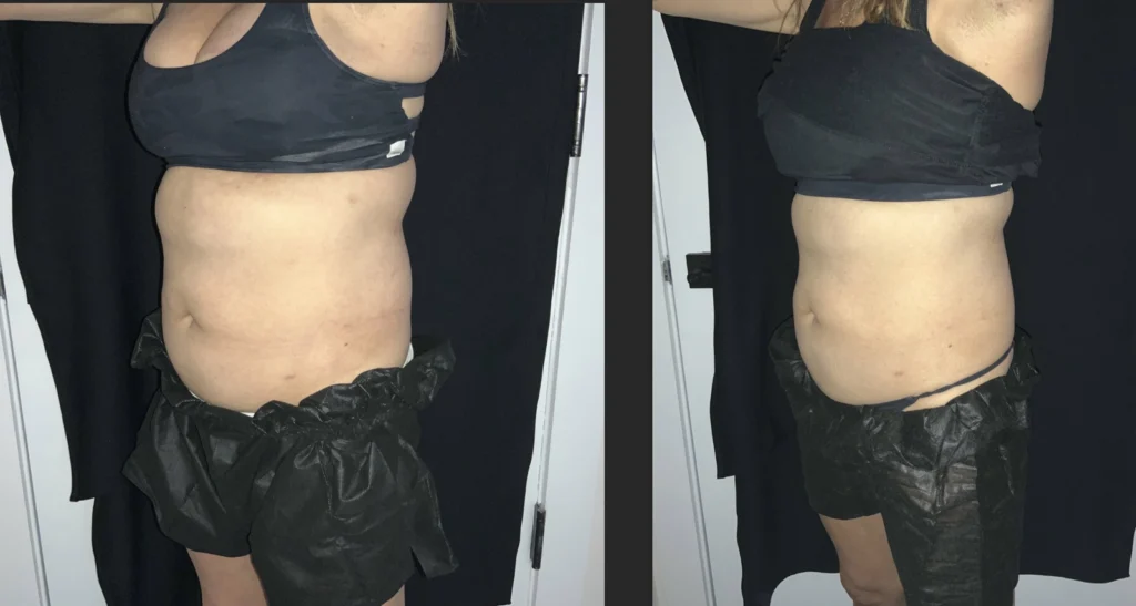 Before and after photo by Jana Kazazic of Fort Worth Medspa in Fort Worth, TX