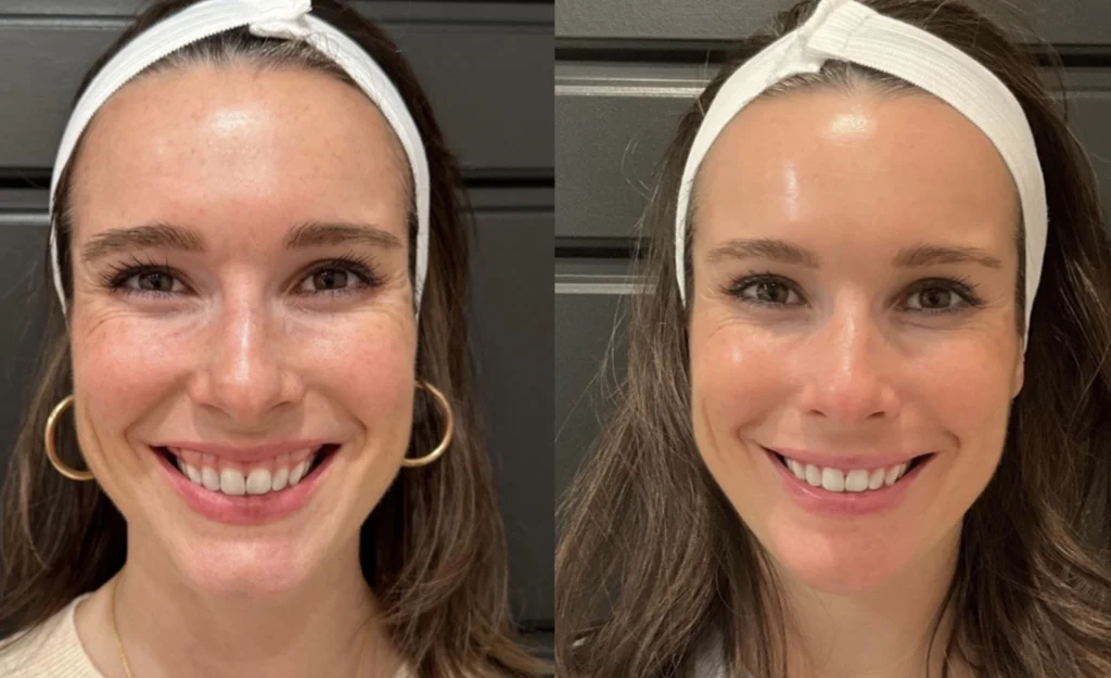 Before and after photo by Jessica Redden of Fort Worth Medspa in Fort Worth, TX