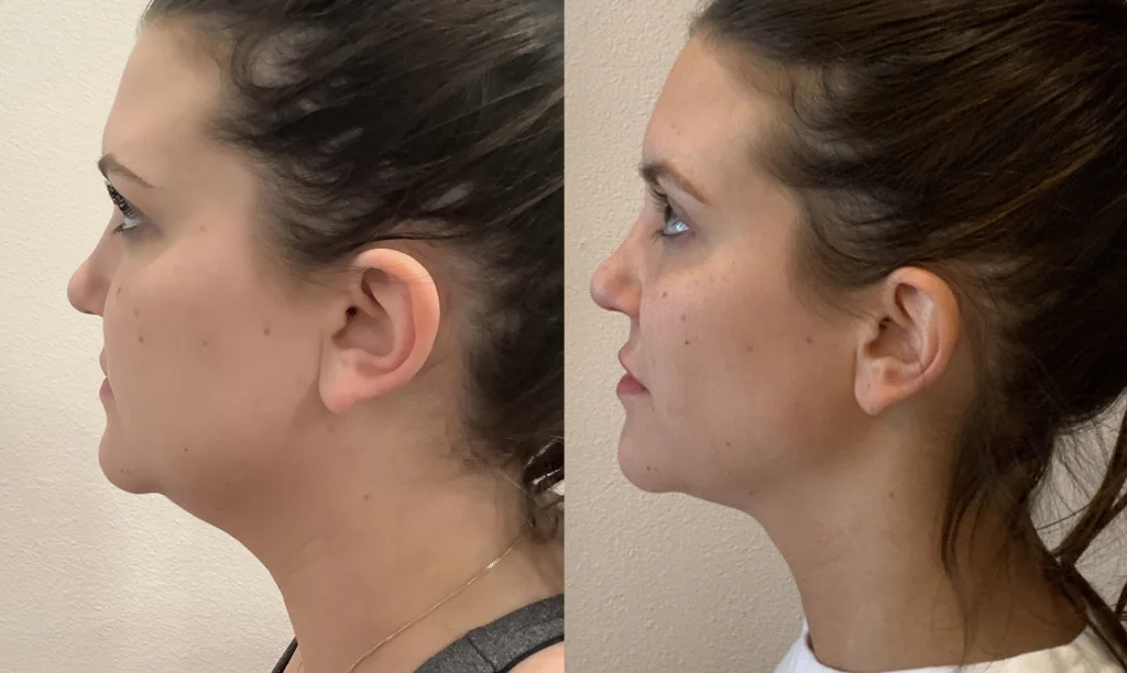 before and after photo by fort worth medspa in fort worth tx