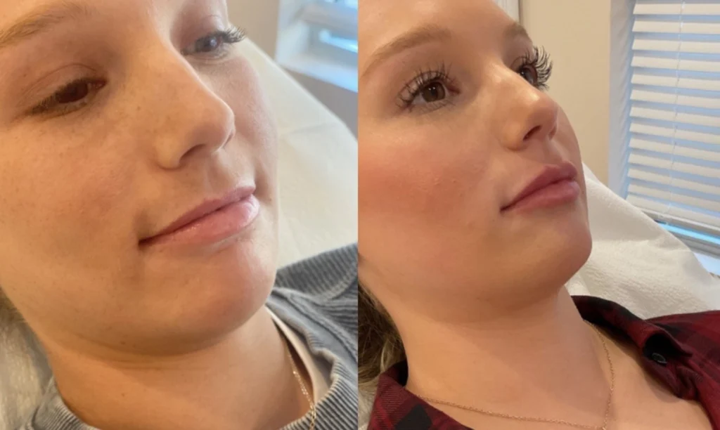 Before and after photo by Tamara Clark of Fort Worth Medspa in Fort Worth, TX