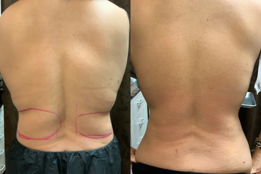 CoolSculpting before and after photo by Fort Worth Medspa in Fort Worth, TX
