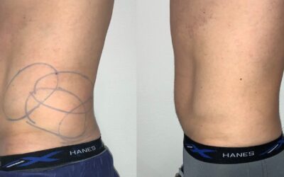 before and after coolsculpting at fort worth medspa