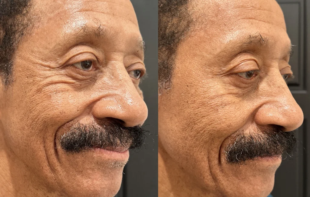 Before and after photo by Hailey Fontana of Fort Worth Medspa in Fort Worth, TX