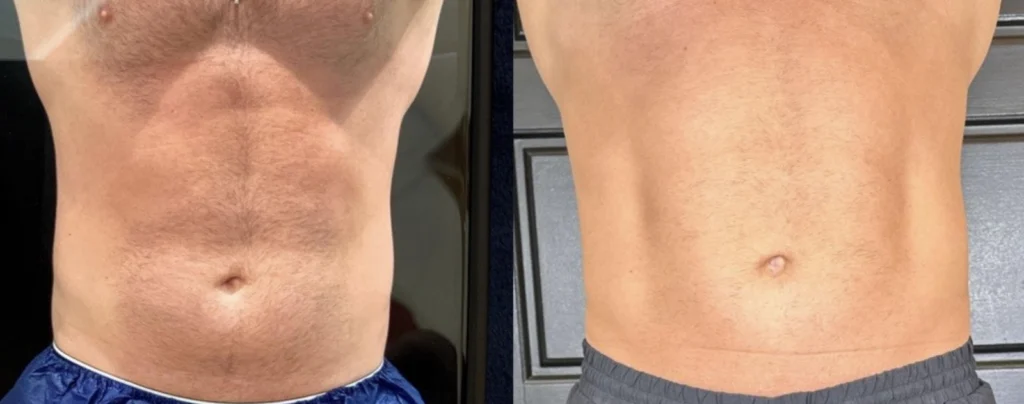 Before and after photo by Helaina Angeletos of Fort Worth Medspa in Fort Worth, TX