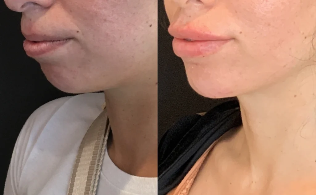 before and after photo by fort worth medspa in fort worth tx