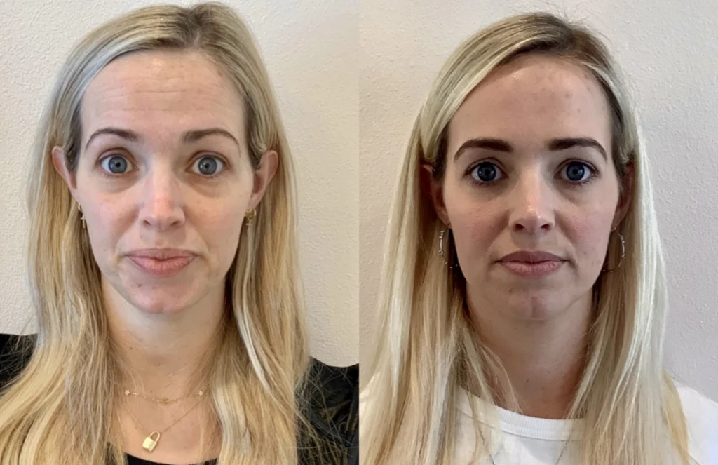 Before and after photo by Tamara Clark of Fort Worth Medspa in Fort Worth, TX