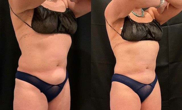 CoolSculpting before and after photo by Fort Worth Medspa in Fort Worth, TX