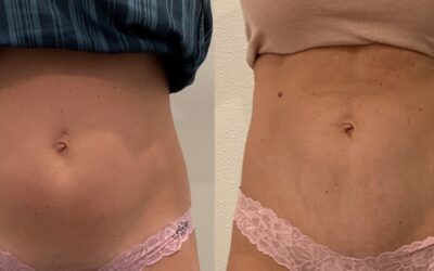 before and after coolsculpting at fort worth medspa