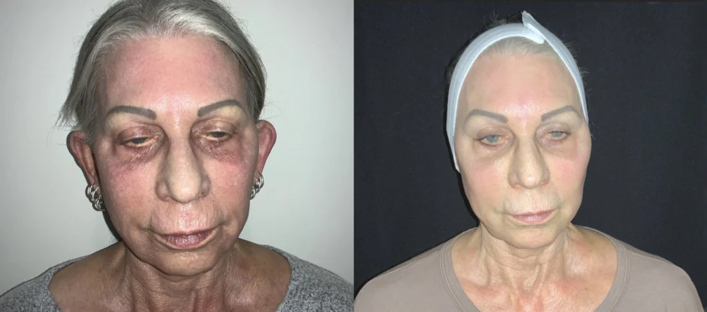 Before and after photo by Jana Kazazic of Fort Worth Medspa in Fort Worth, TX