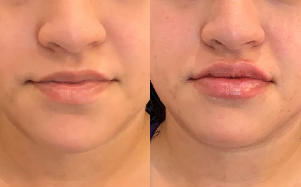 before and after photo by fort worth medspa in fort worth tx