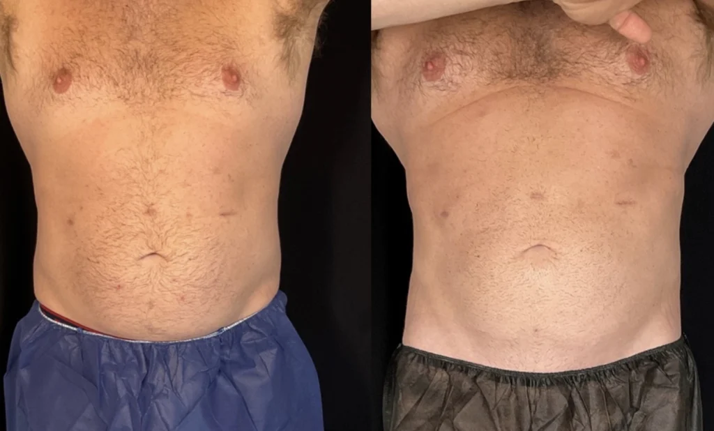 Before and after photo by Tamara Clark of Fort Worth Medspa in Fort Worth, TX