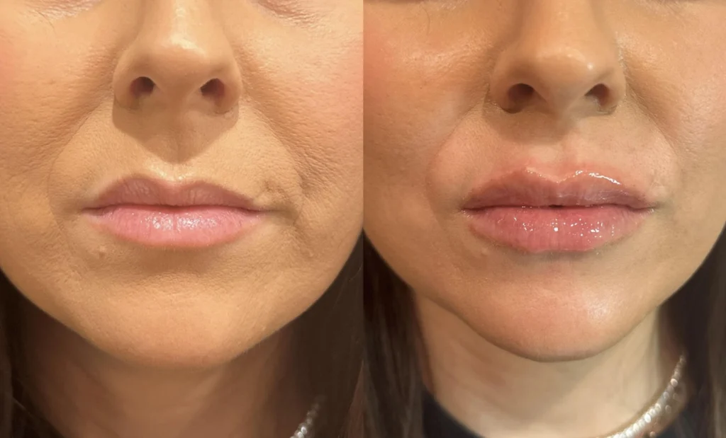 Before and after photo by Hailey Fontana of Fort Worth Medspa in Fort Worth, TX