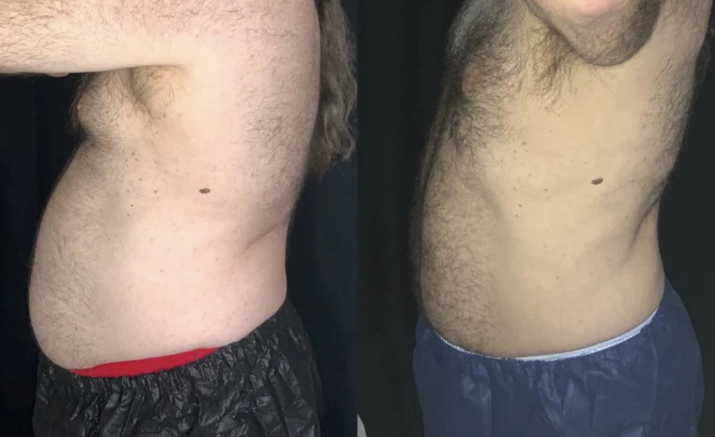 Before and after photo by Jana Kazazic of Fort Worth Medspa in Fort Worth, TX