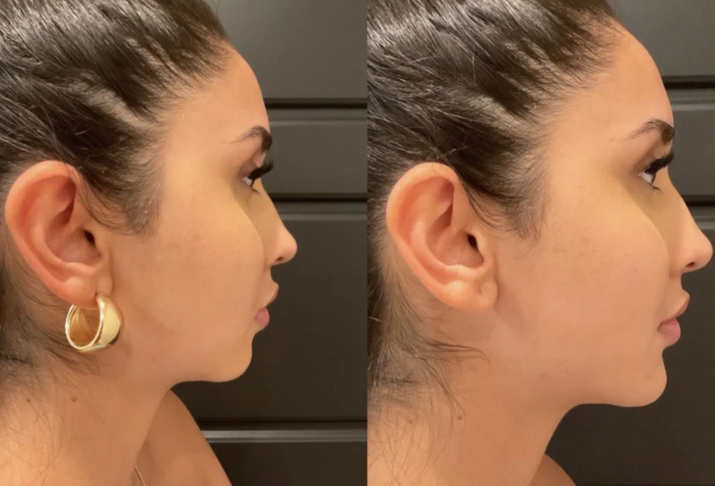 Before and after photo by Jessica Redden of Fort Worth Medspa in Fort Worth, TX