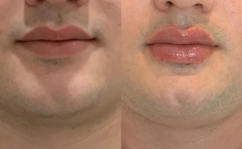 before and after photo by fort worth medspa in fort worth tx