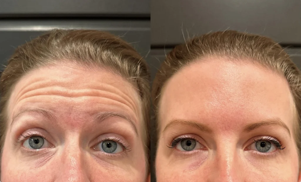 Before and after photo by Hailey Fontana of Fort Worth Medspa in Fort Worth, TX