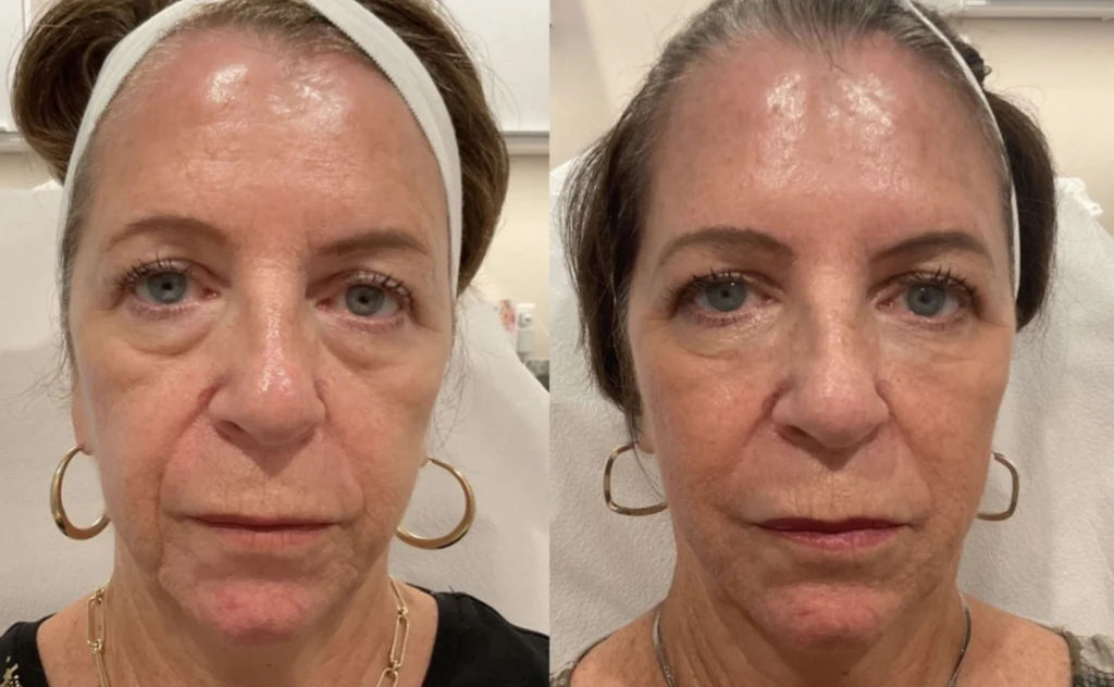 Before and after photo by Jessica Redden of Fort Worth Medspa in Fort Worth, TX
