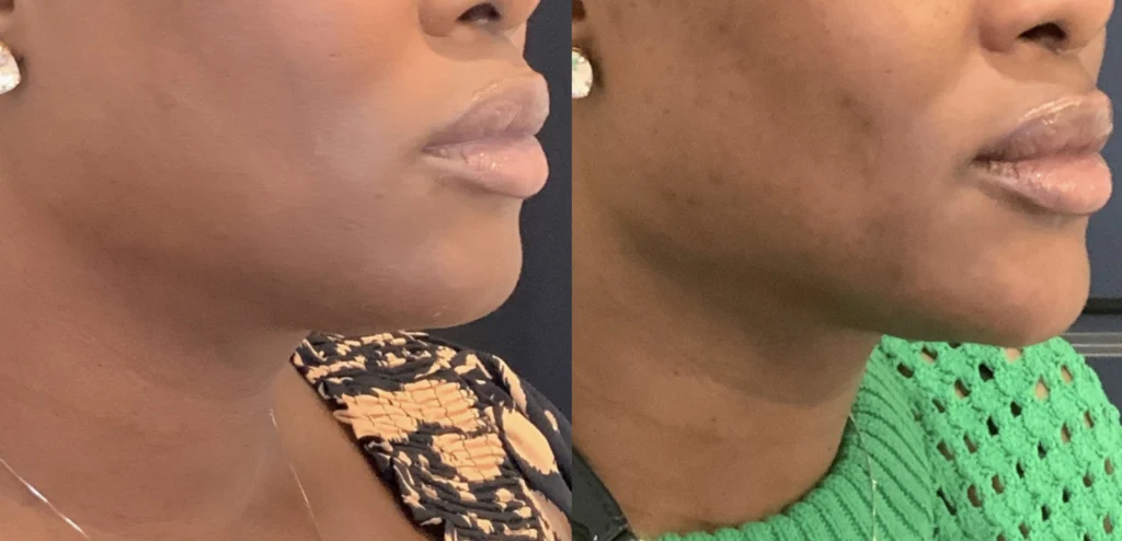 before and after photo by fort worth medspa in fort worth tx