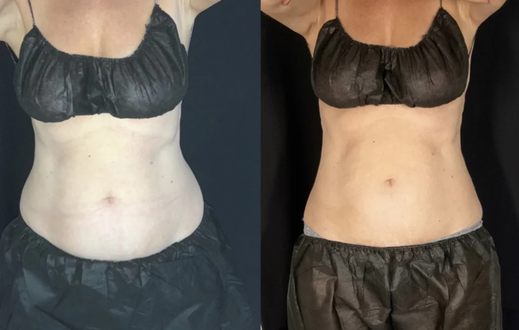 Before and after photo by Tamara Clark of Fort Worth Medspa in Fort Worth, TX