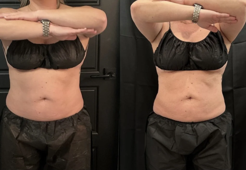 CoolSculpting before and after photo by Fort Worth Medspa in Fort Worth, TX
