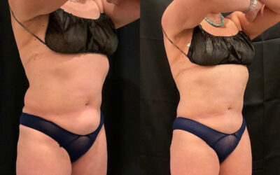 before and after coolsculpting at fort worth medspa
